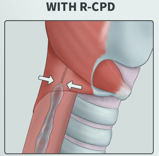 Anatomy of RCPD, where the cricopharyngeus stays tight and traps air