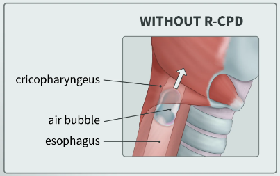 Anatomy of a normal burp, where the cricopharyngeus relaxes to release air